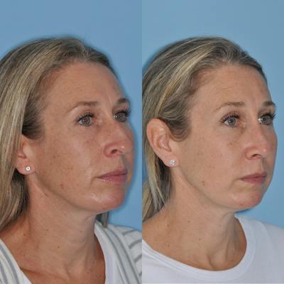 Rhinoplasty Before & After Gallery - Patient 530371 - Image 1