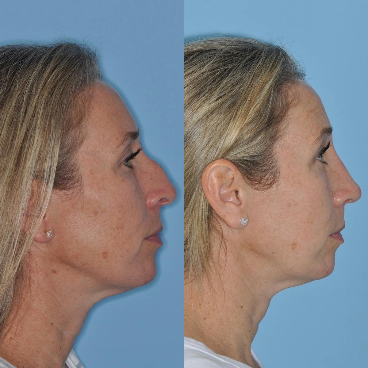 Rhinoplasty Before & After Gallery - Patient 530371 - Image 3