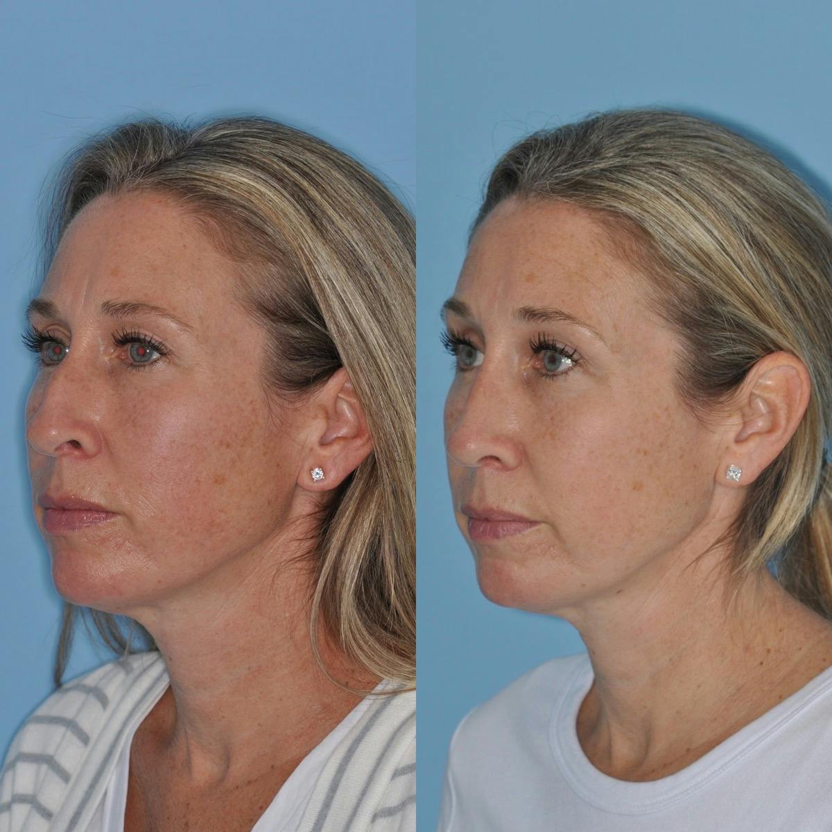 Rhinoplasty Before & After Gallery - Patient 530371 - Image 4