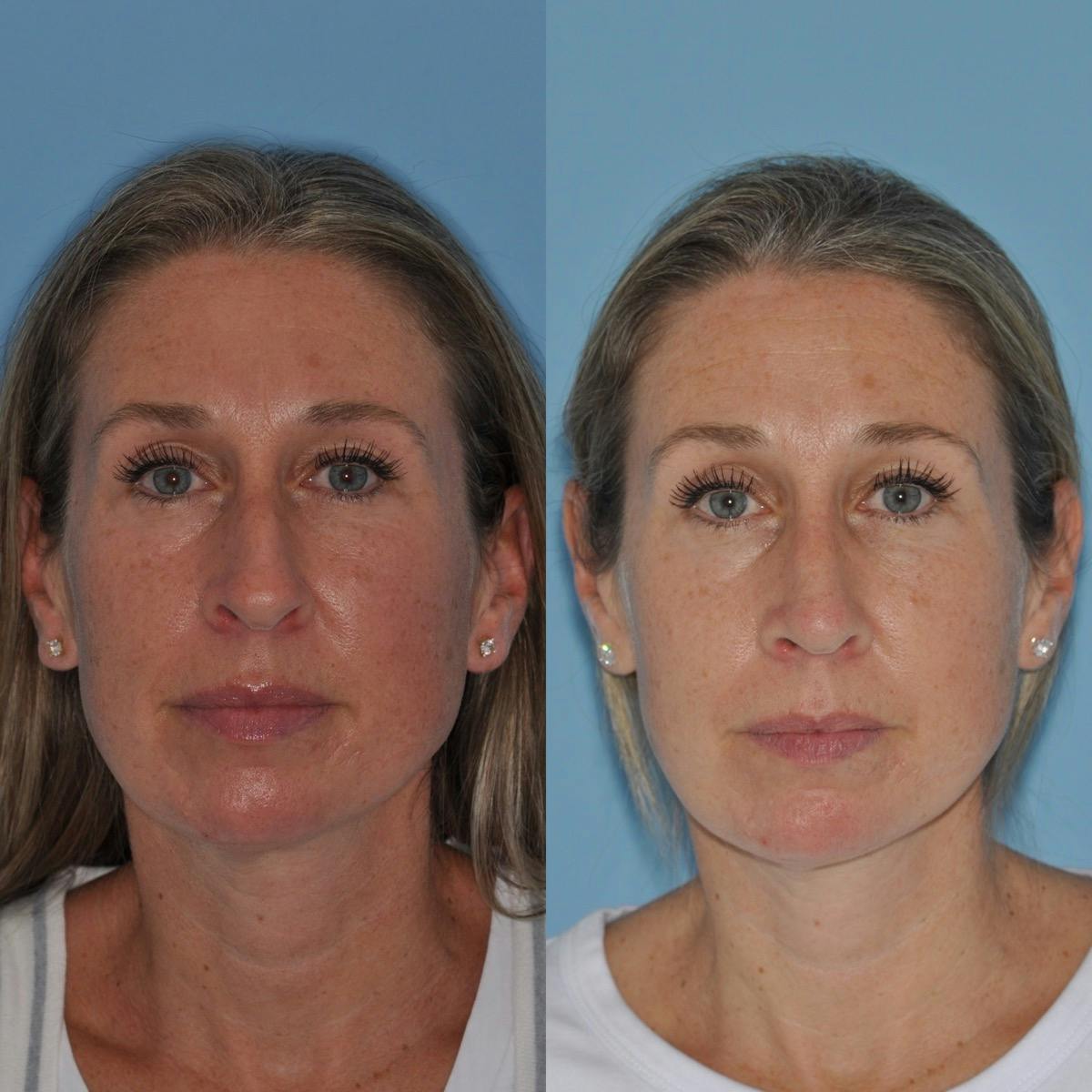 Rhinoplasty Before & After Gallery - Patient 530371 - Image 6