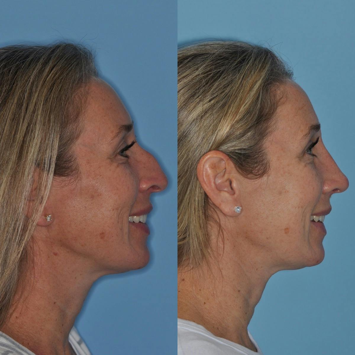 Rhinoplasty Before & After Gallery - Patient 530371 - Image 7