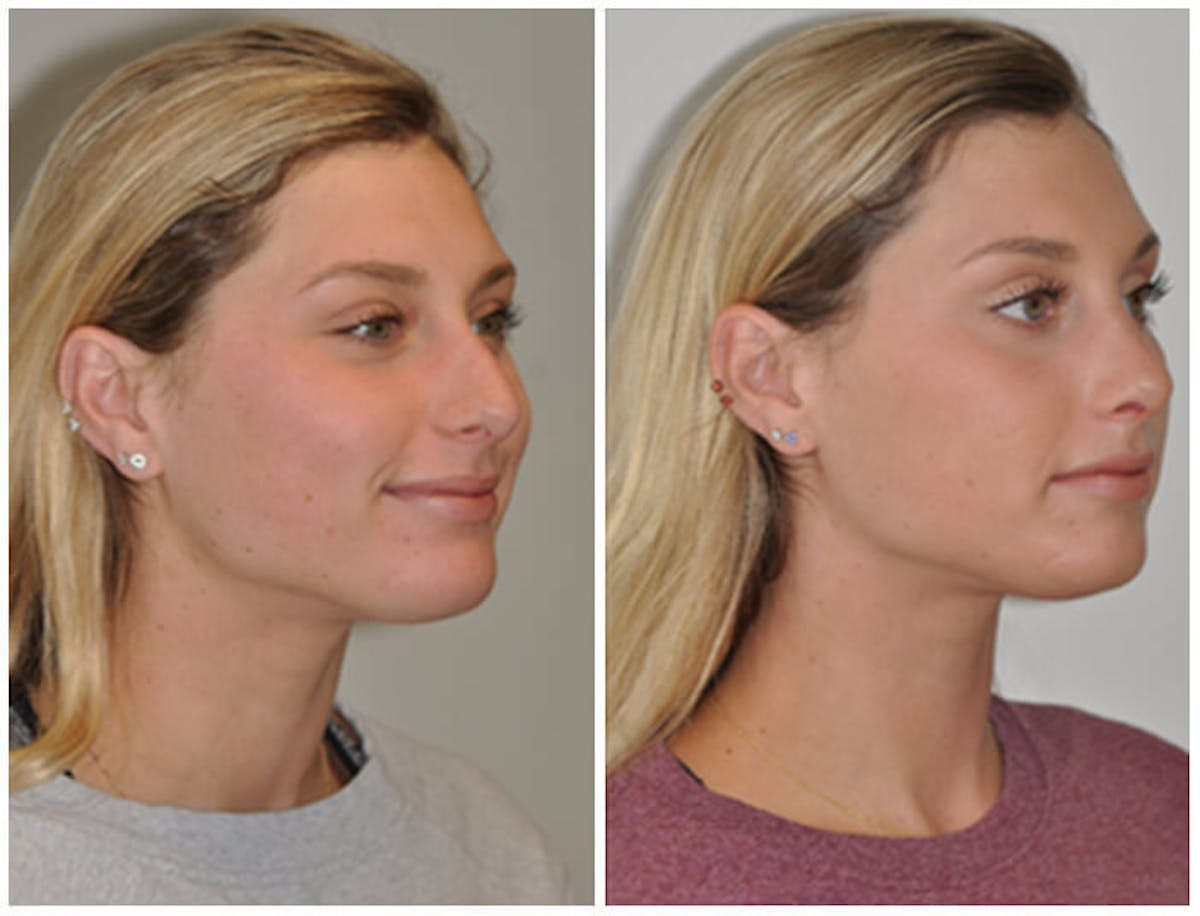 Rhinoplasty Before & After Gallery - Patient 107779 - Image 1