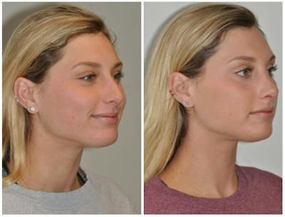 Rhinoplasty Before & After Gallery - Patient 107779 - Image 1