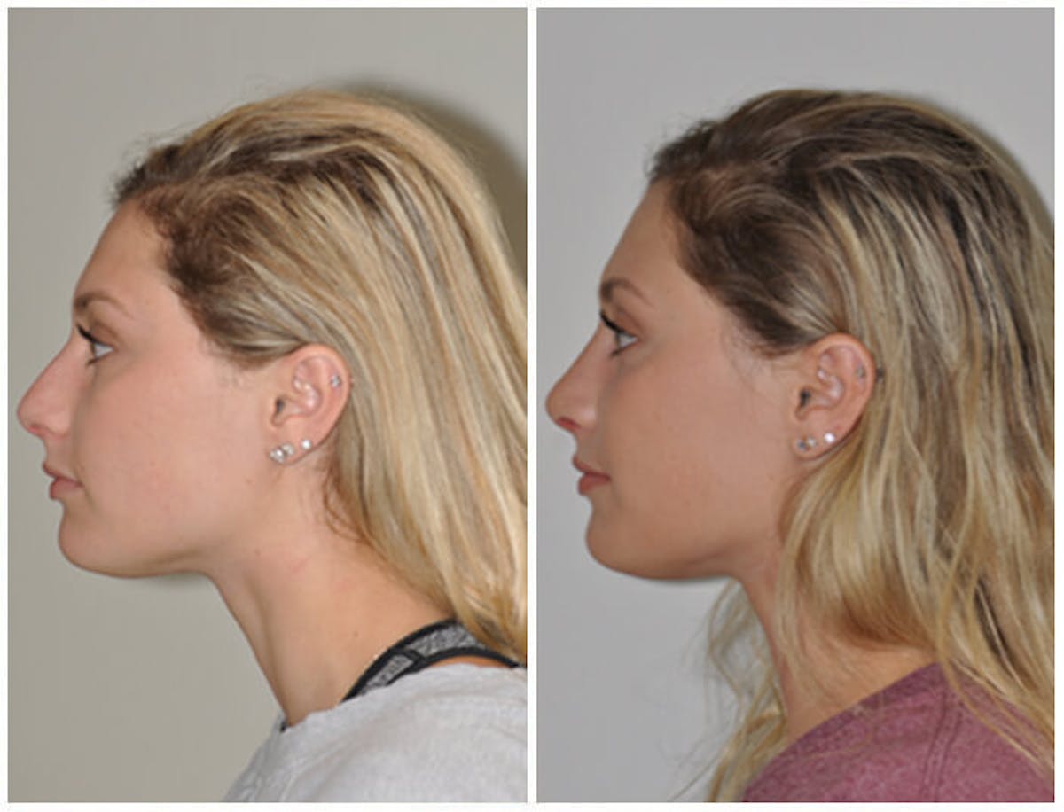 Rhinoplasty Before & After Gallery - Patient 107779 - Image 2