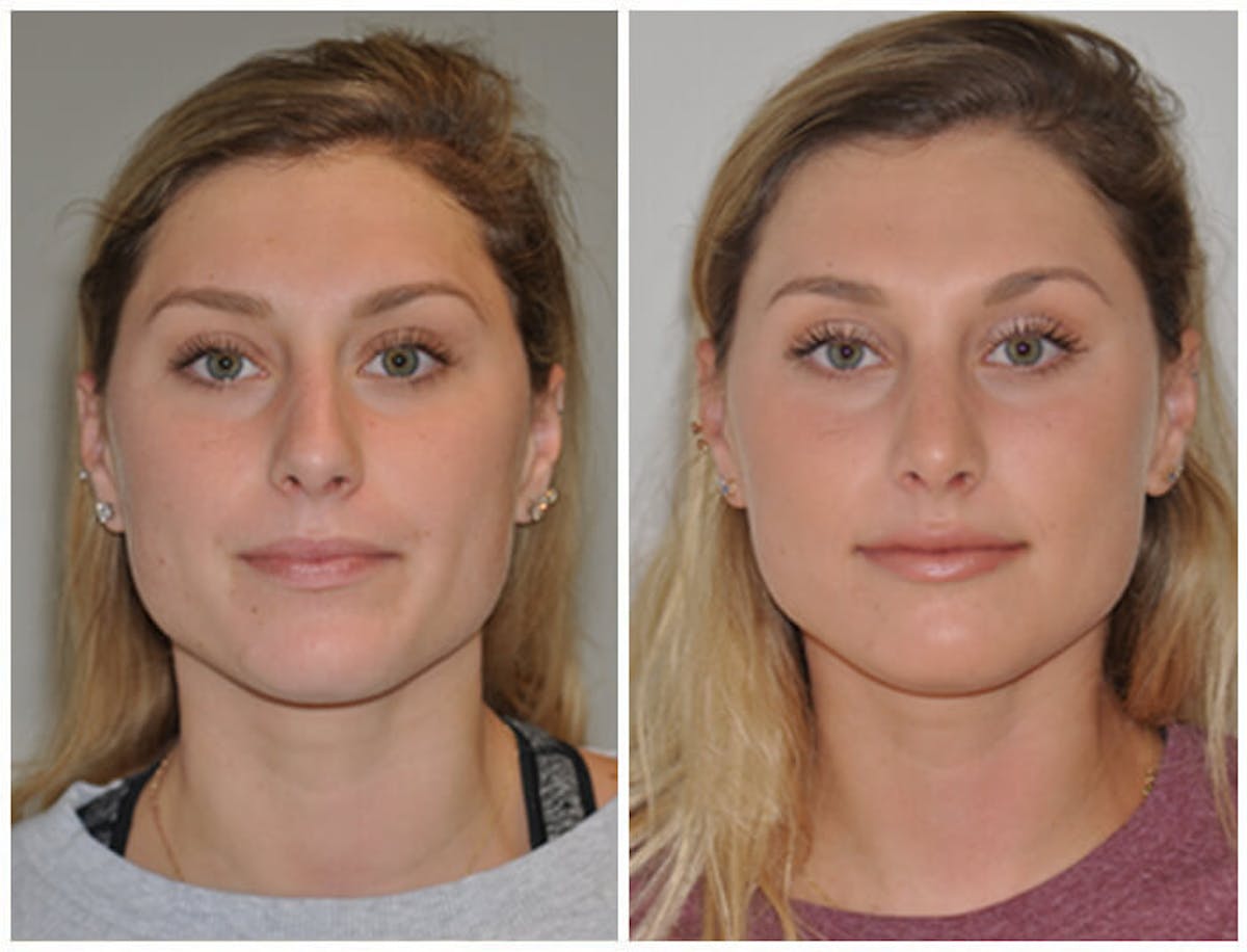 Rhinoplasty Before & After Gallery - Patient 107779 - Image 3