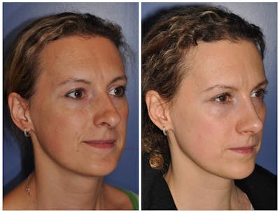 Rhinoplasty Before & After Gallery - Patient 205804 - Image 1