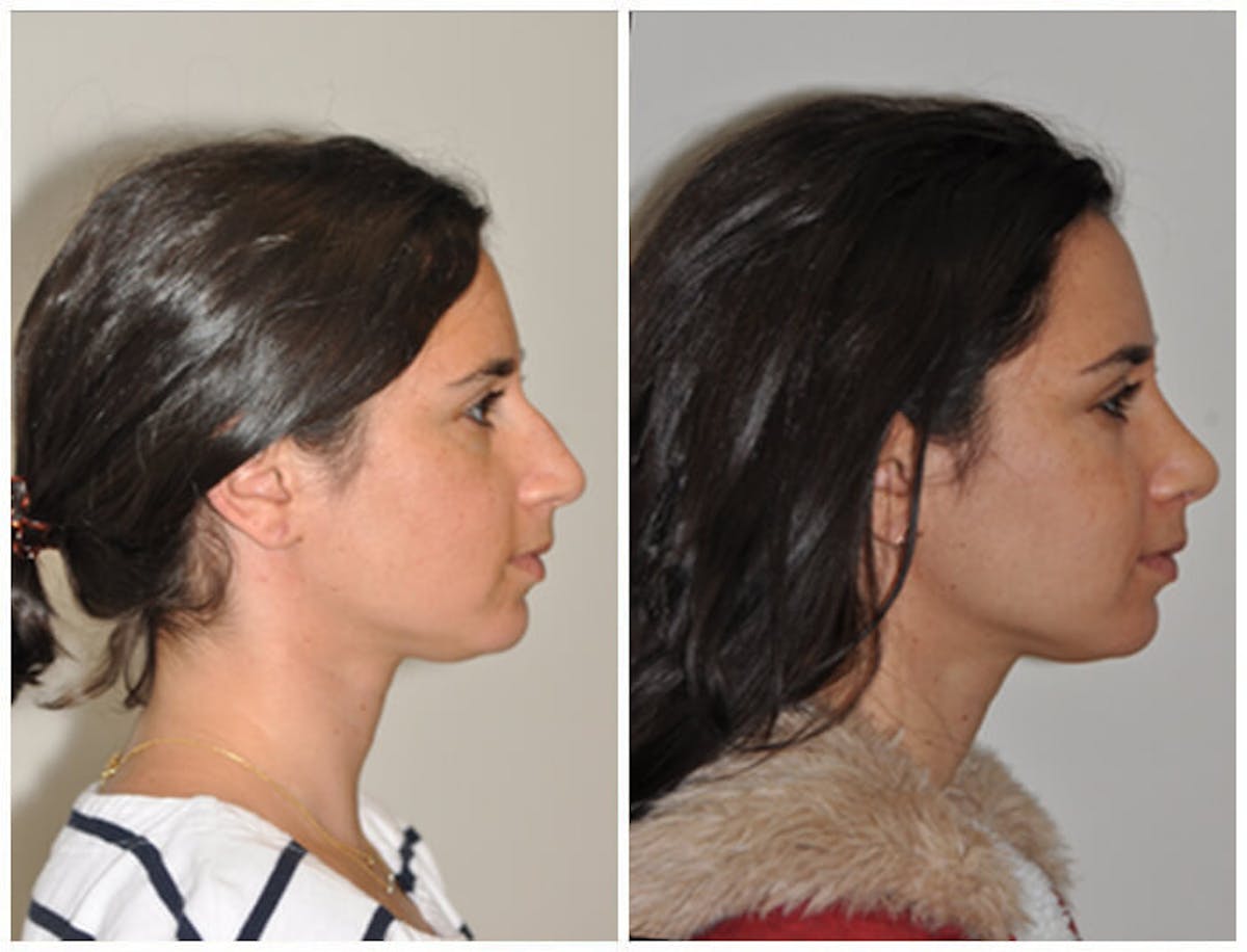 Rhinoplasty Before & After Gallery - Patient 220045 - Image 1