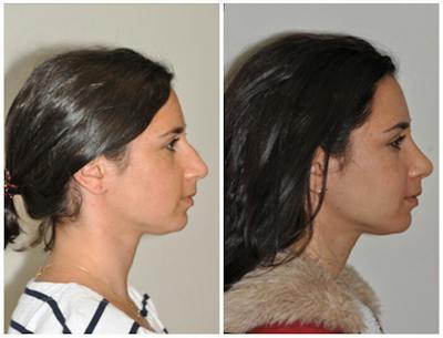 Rhinoplasty Before & After Gallery - Patient 220045 - Image 1