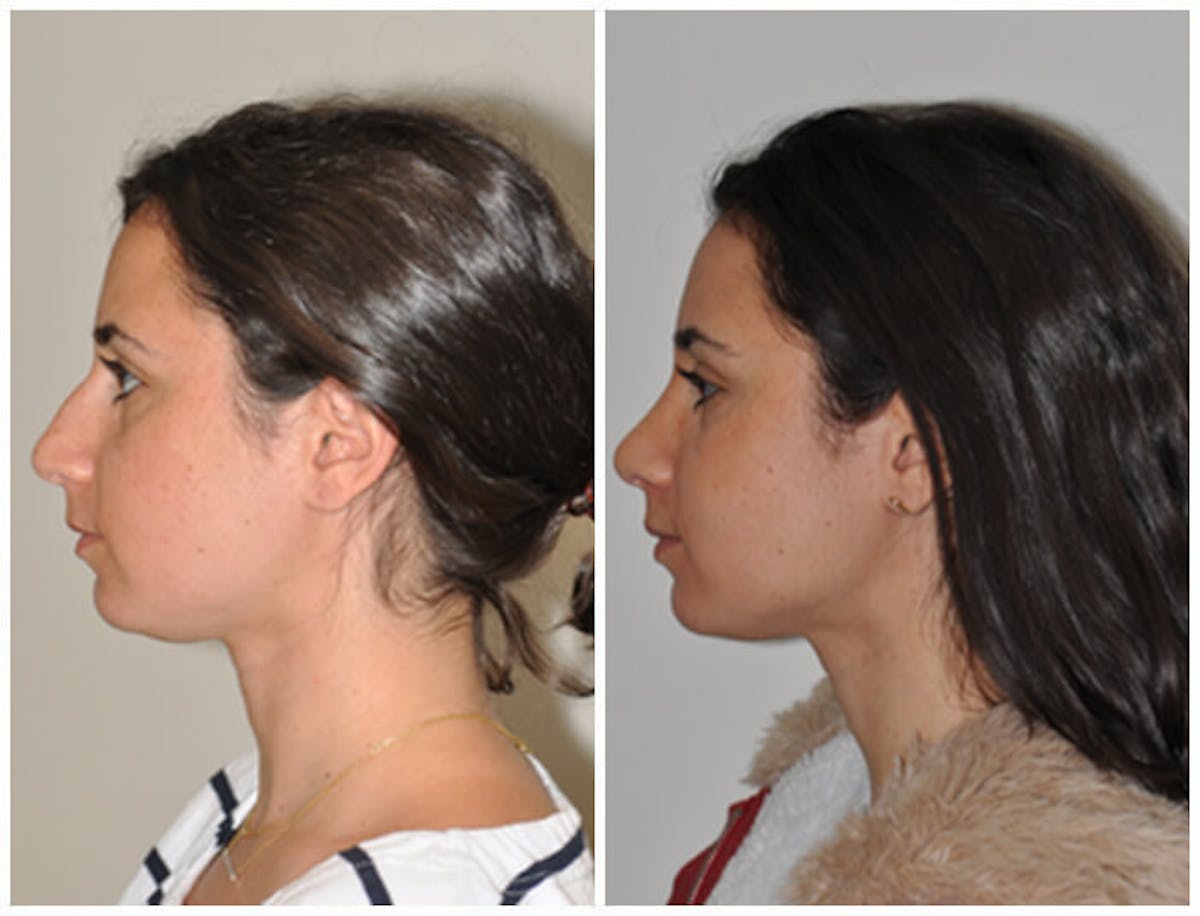 Rhinoplasty Before & After Gallery - Patient 220045 - Image 2