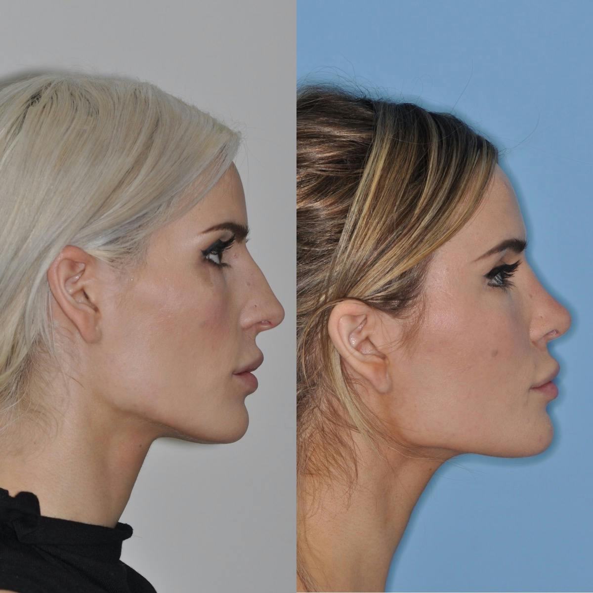 Rhinoplasty Before & After Gallery - Patient 103197 - Image 1