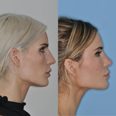 Rhinoplasty Before & After Gallery - Patient 103197 - Image 1