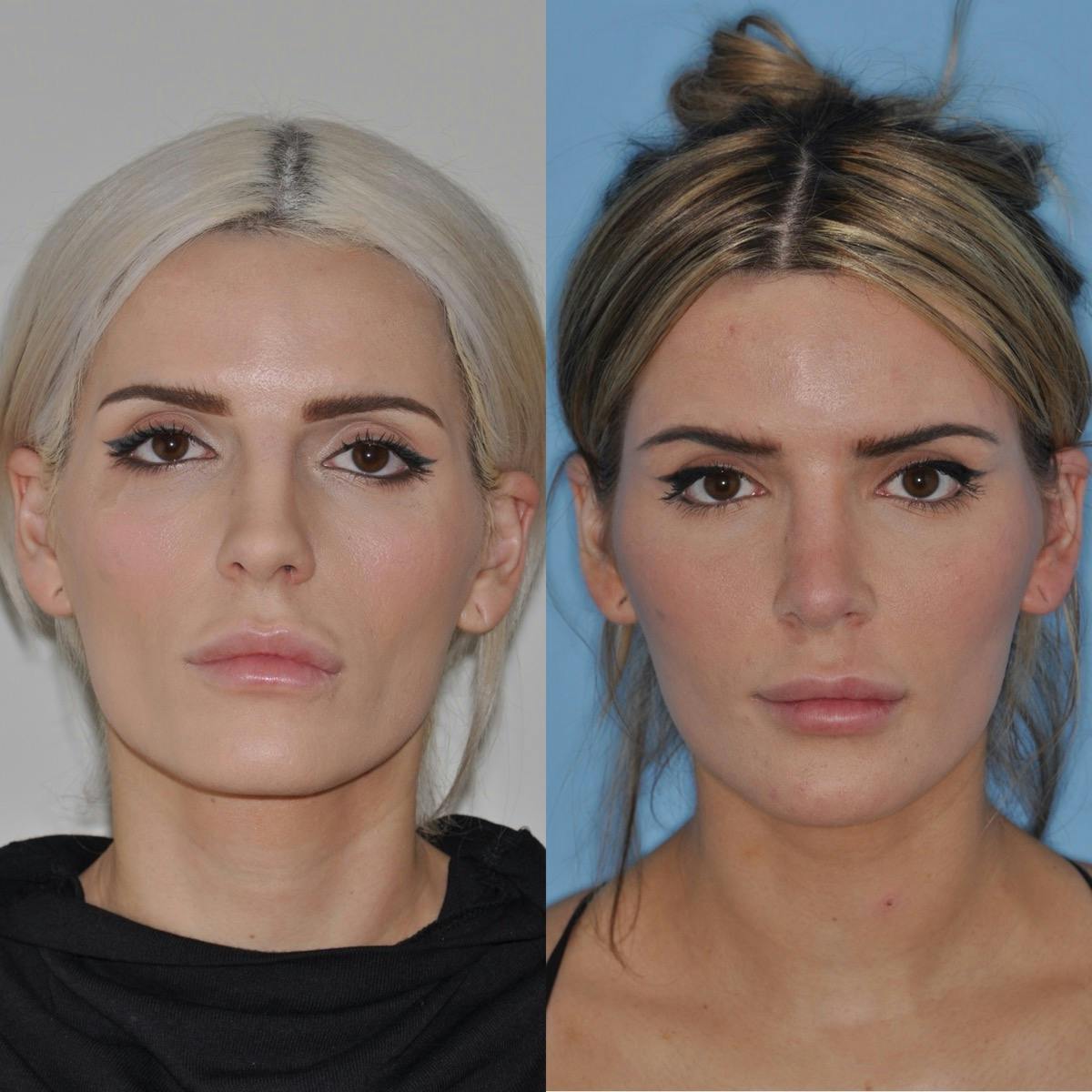 Rhinoplasty Before & After Gallery - Patient 103197 - Image 2