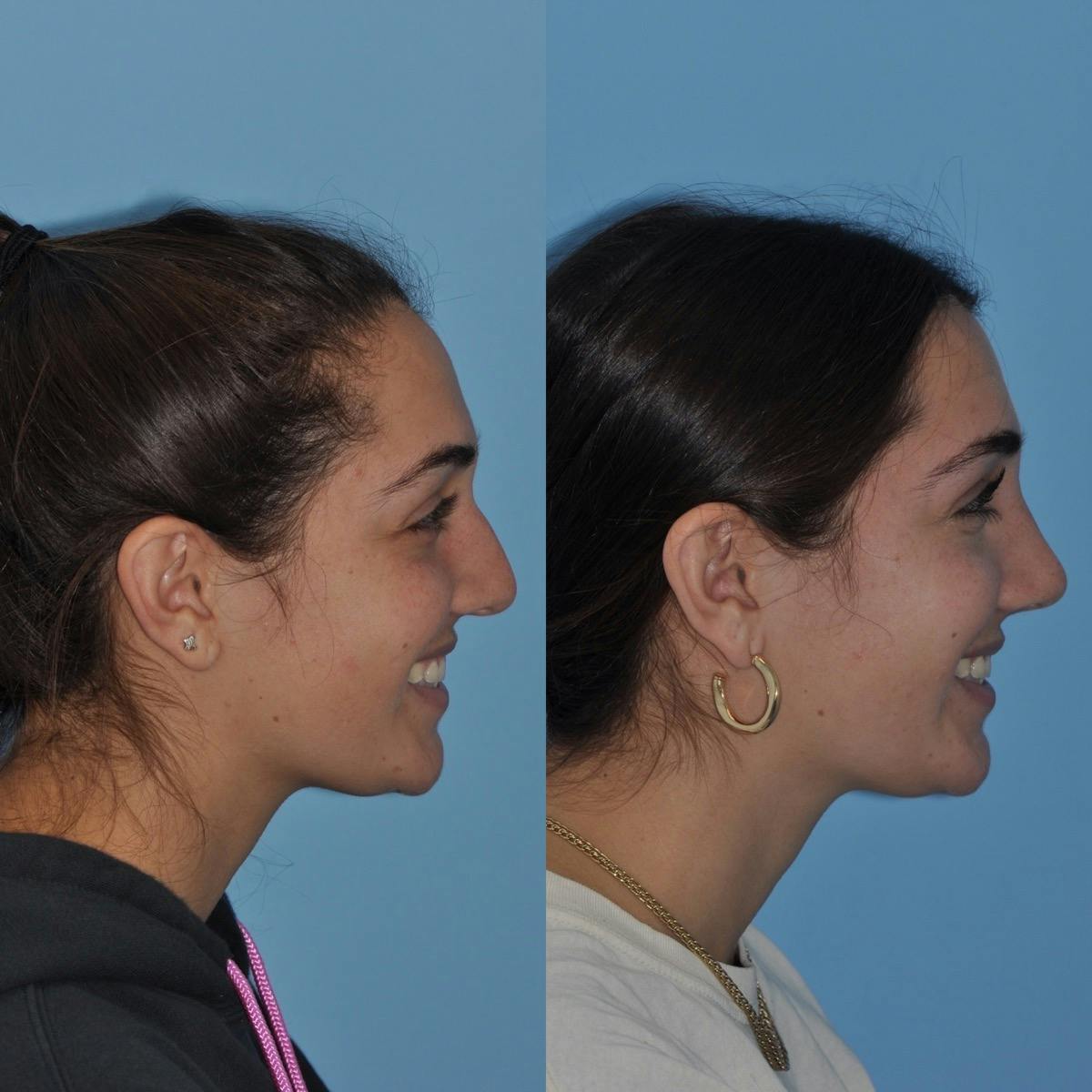 Rhinoplasty Before & After Gallery - Patient 106665 - Image 2
