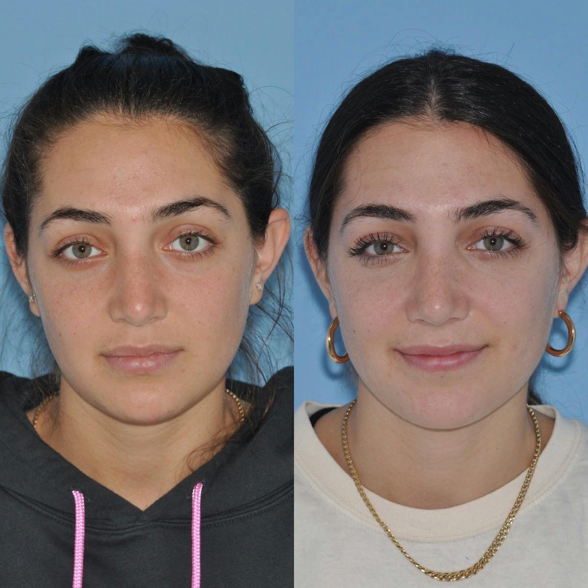 Rhinoplasty Before & After Gallery - Patient 106665 - Image 3