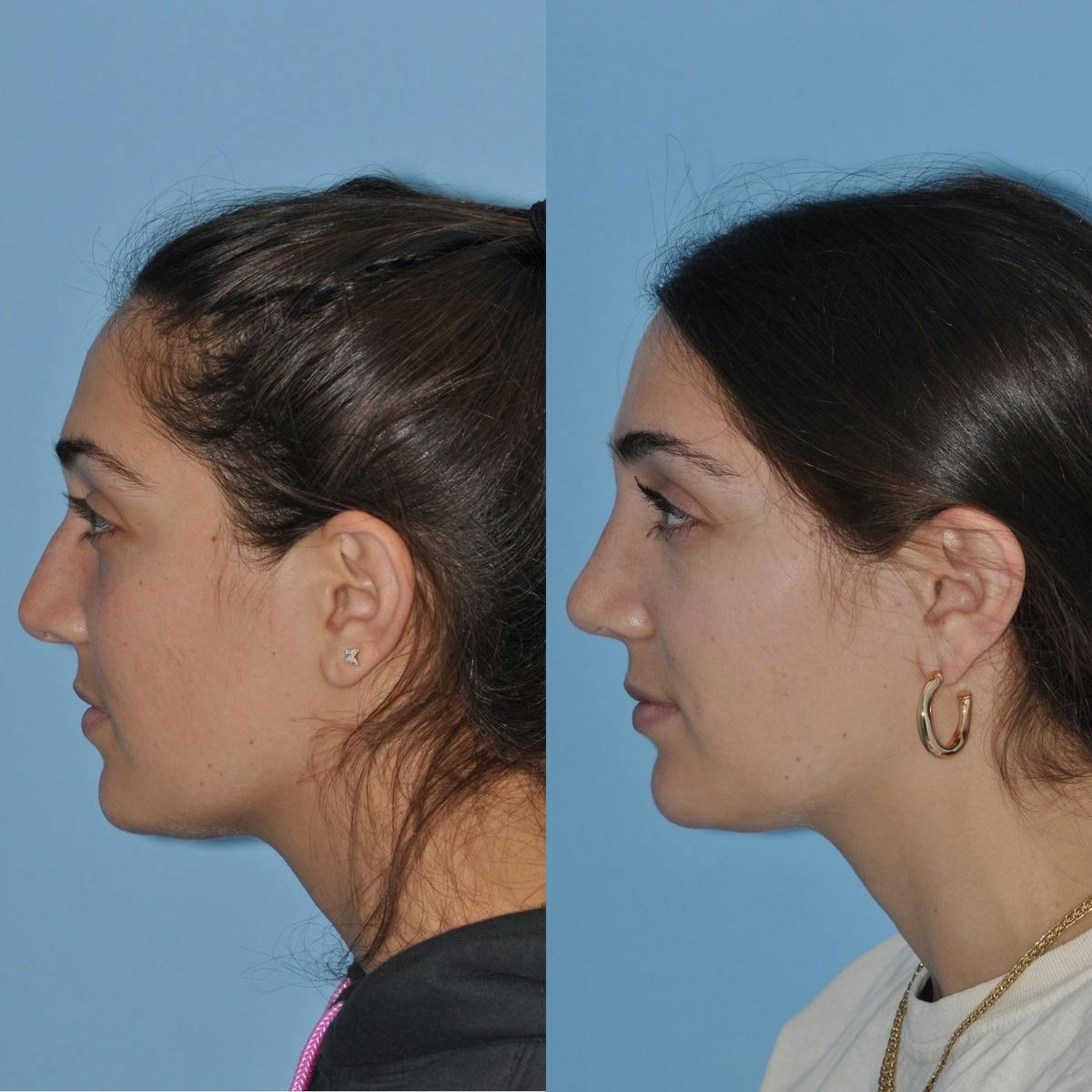 Rhinoplasty Before & After Gallery - Patient 106665 - Image 6