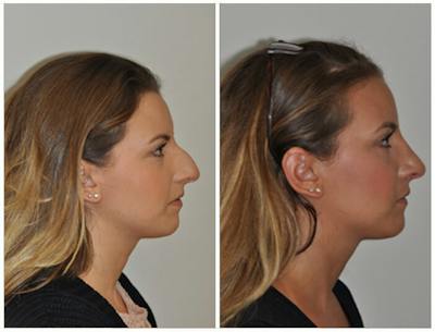 Rhinoplasty Before & After Gallery - Patient 407384 - Image 1