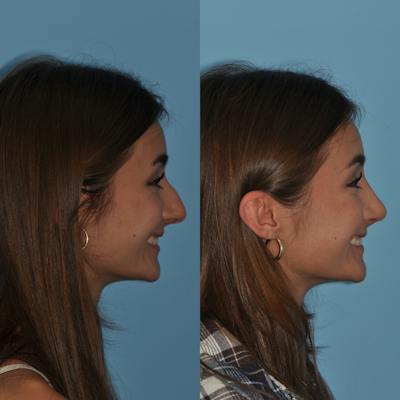 Rhinoplasty Before & After Gallery - Patient 362743 - Image 1