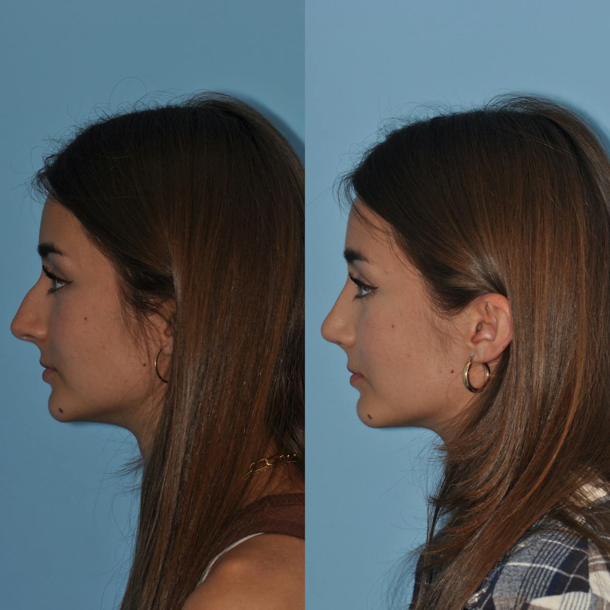 Rhinoplasty Before & After Gallery - Patient 362743 - Image 2