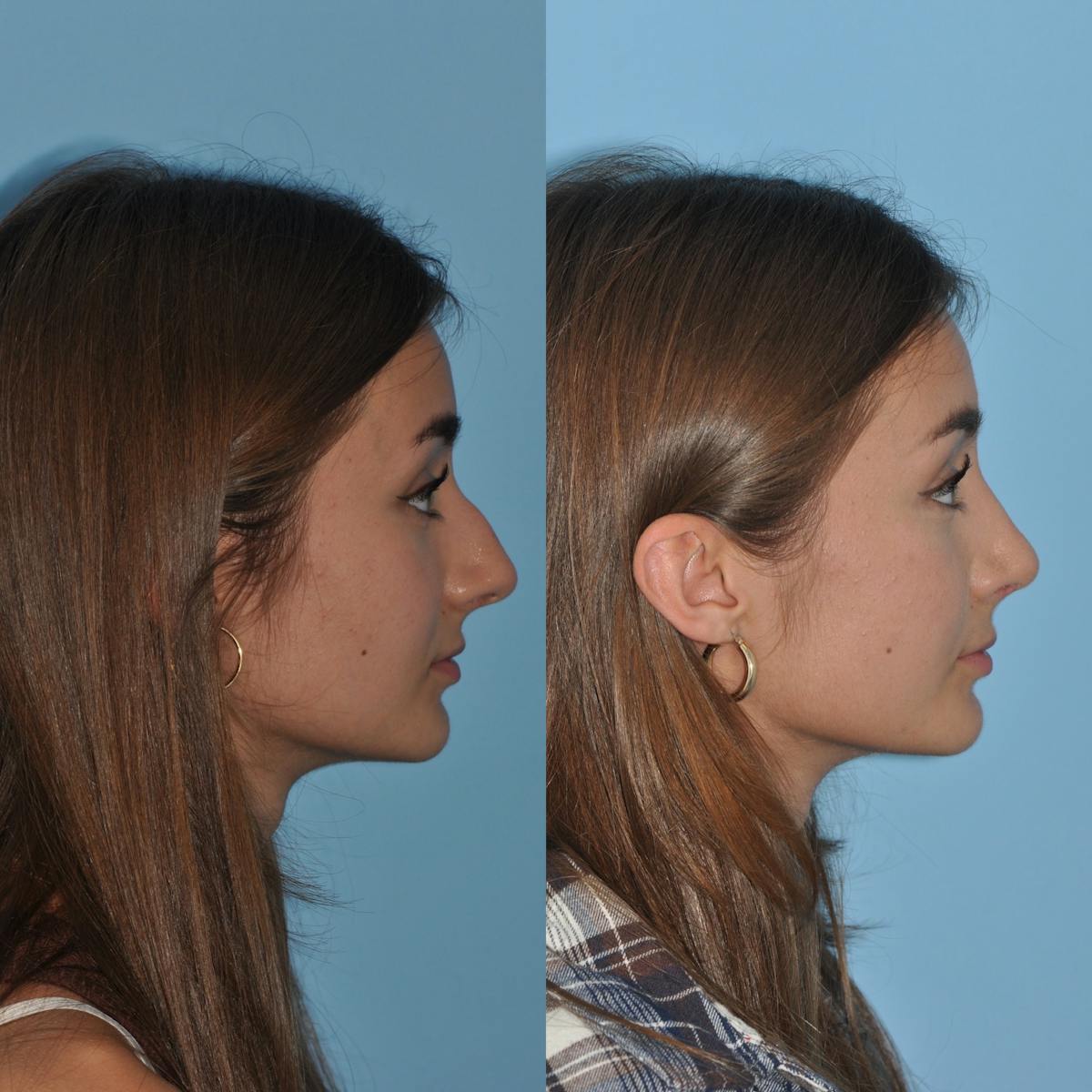 Rhinoplasty Before & After Gallery - Patient 362743 - Image 3