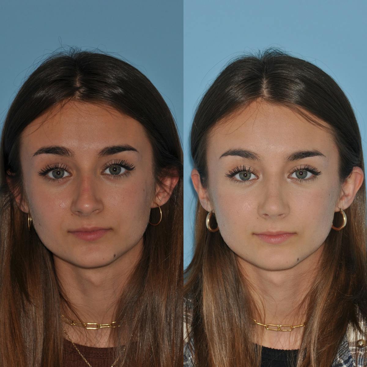 Rhinoplasty Before & After Gallery - Patient 362743 - Image 4