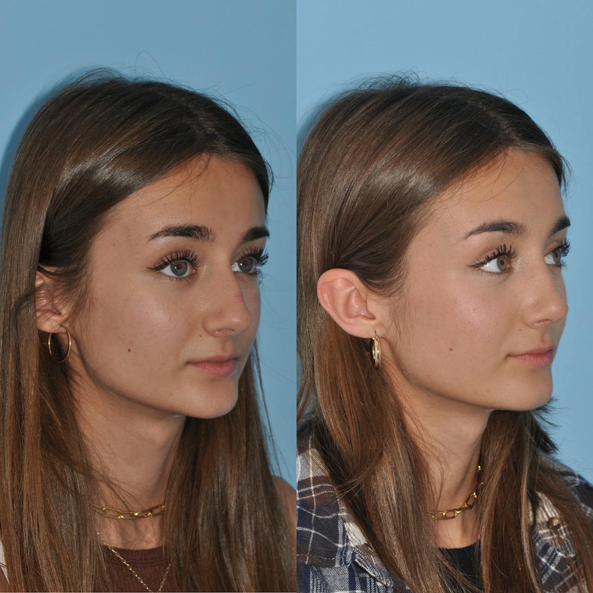 Rhinoplasty Before & After Gallery - Patient 362743 - Image 6