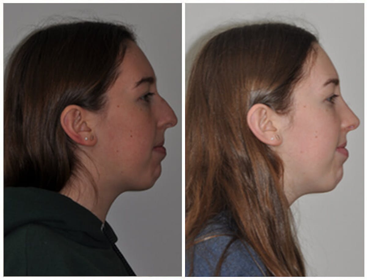 Rhinoplasty Before & After Gallery - Patient 897441 - Image 1