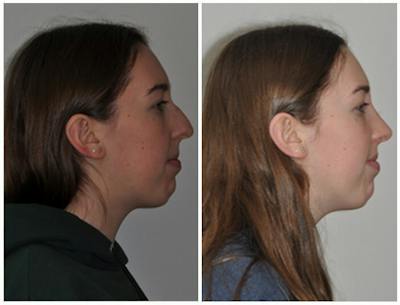 Rhinoplasty Before & After Gallery - Patient 897441 - Image 1