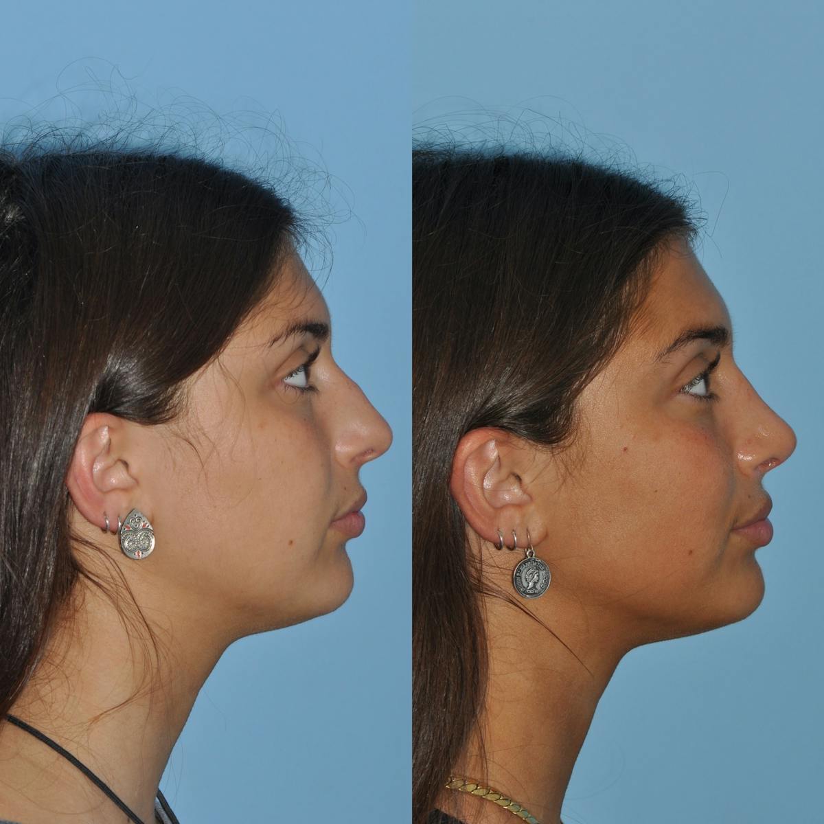 Rhinoplasty Before & After Gallery - Patient 363320 - Image 1