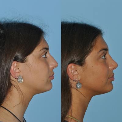 Rhinoplasty Before & After Gallery - Patient 363320 - Image 1