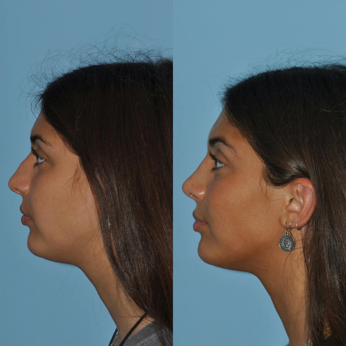 Rhinoplasty Before & After Gallery - Patient 363320 - Image 3