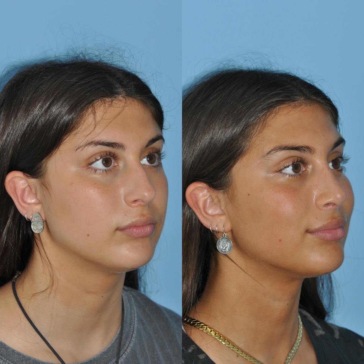 Rhinoplasty Before & After Gallery - Patient 363320 - Image 5
