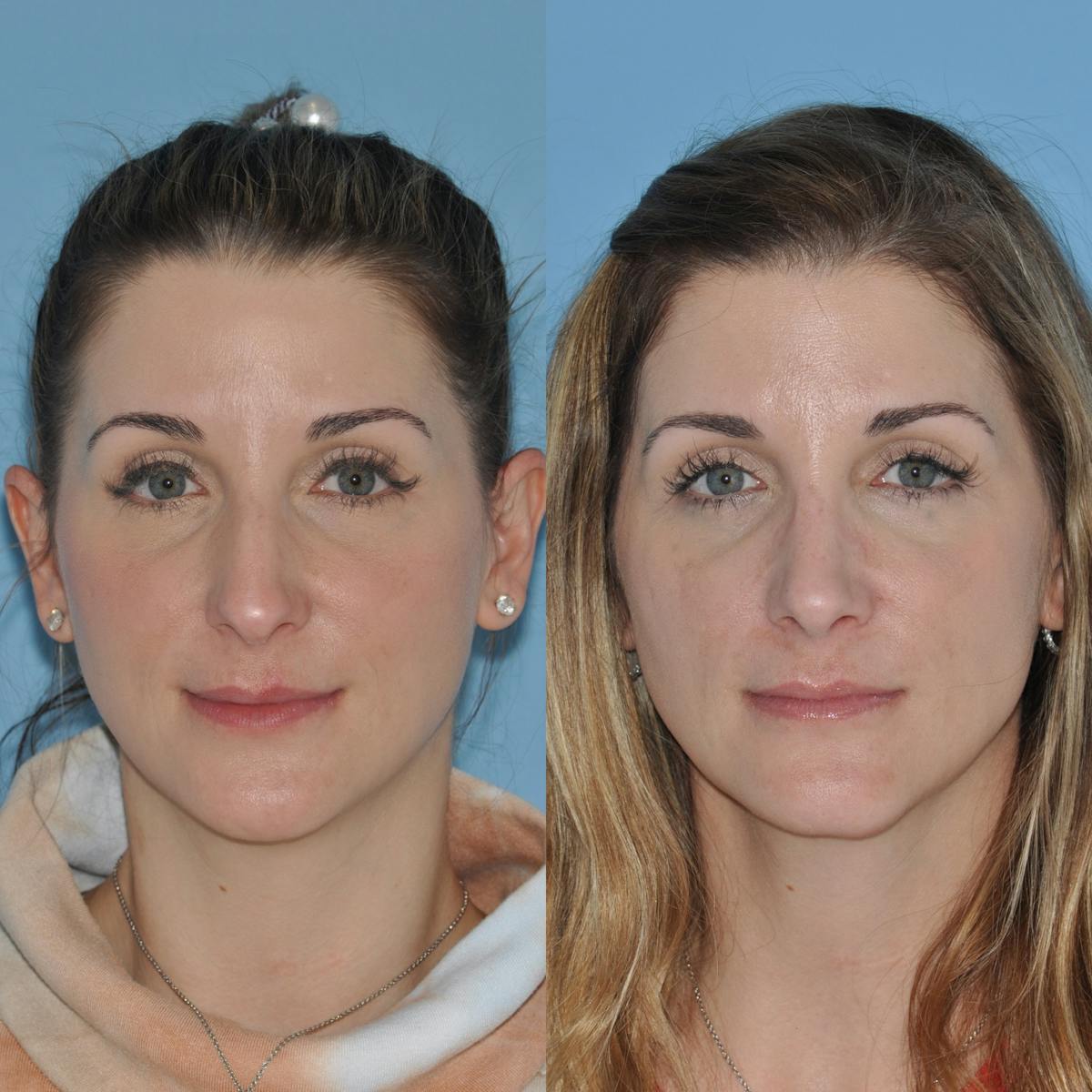 Rhinoplasty Before & After Gallery - Patient 163514 - Image 2