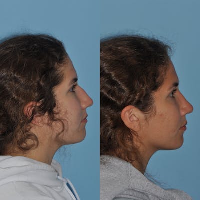 Rhinoplasty Before & After Gallery - Patient 302718 - Image 1