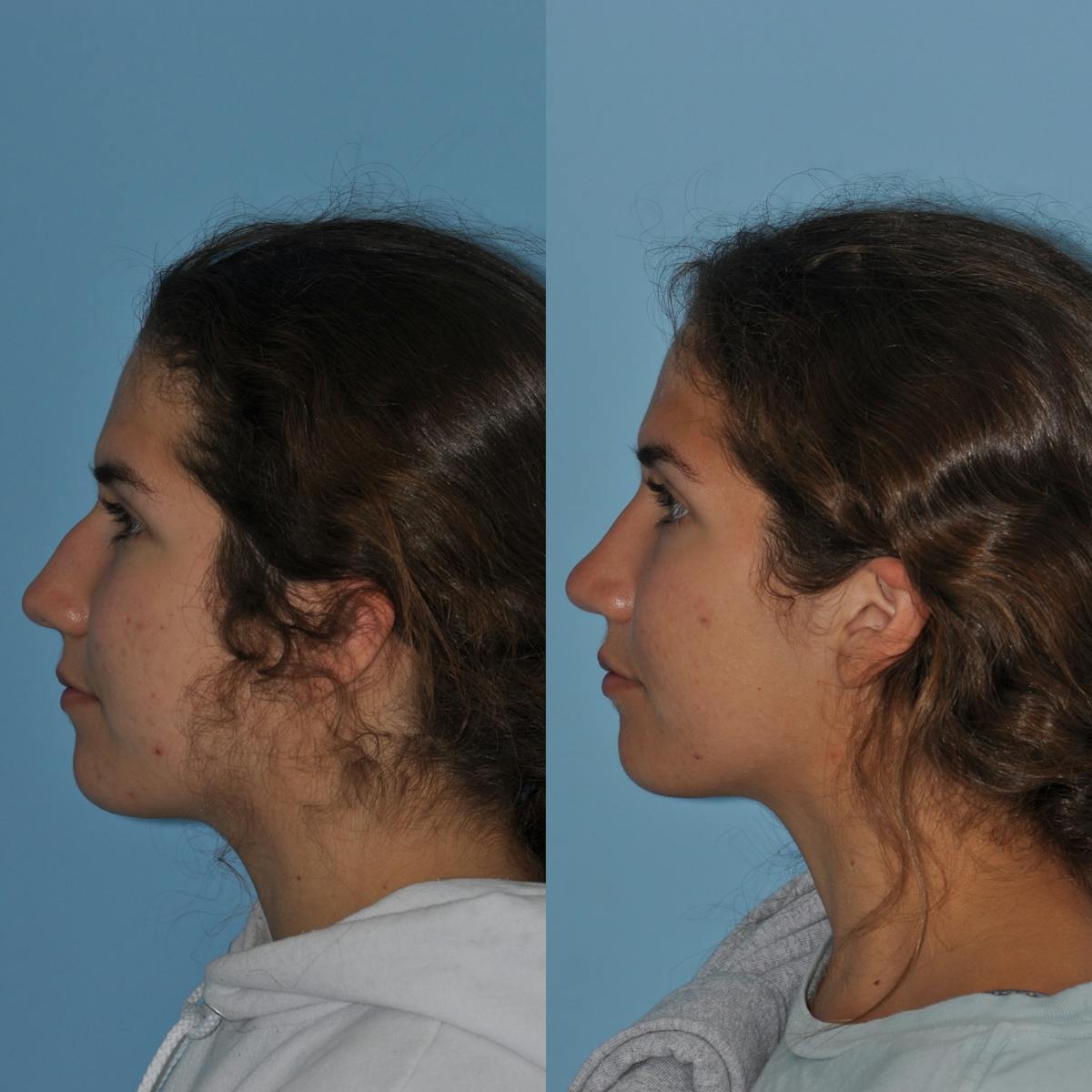 Rhinoplasty Before & After Gallery - Patient 302718 - Image 2