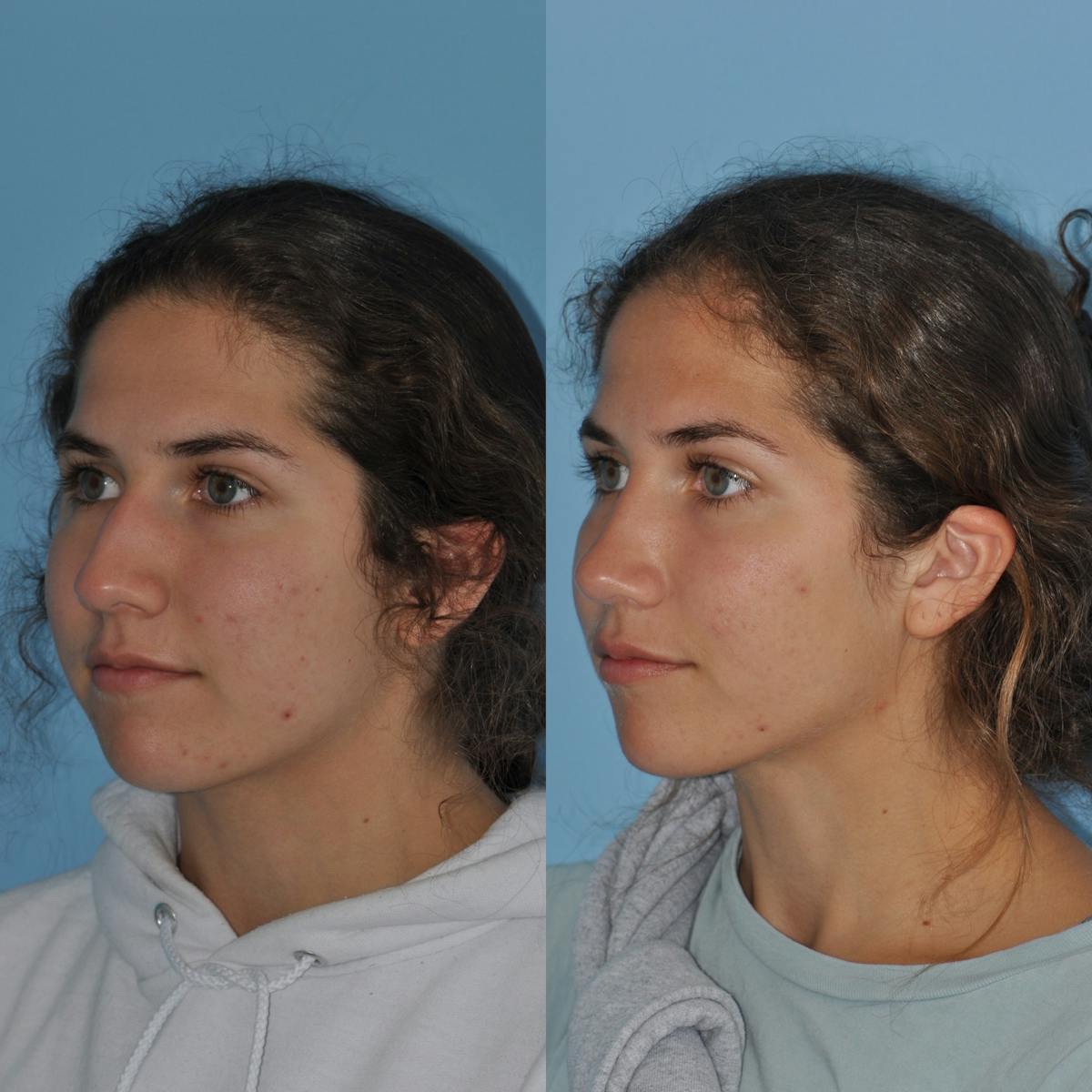 Rhinoplasty Before & After Gallery - Patient 302718 - Image 6