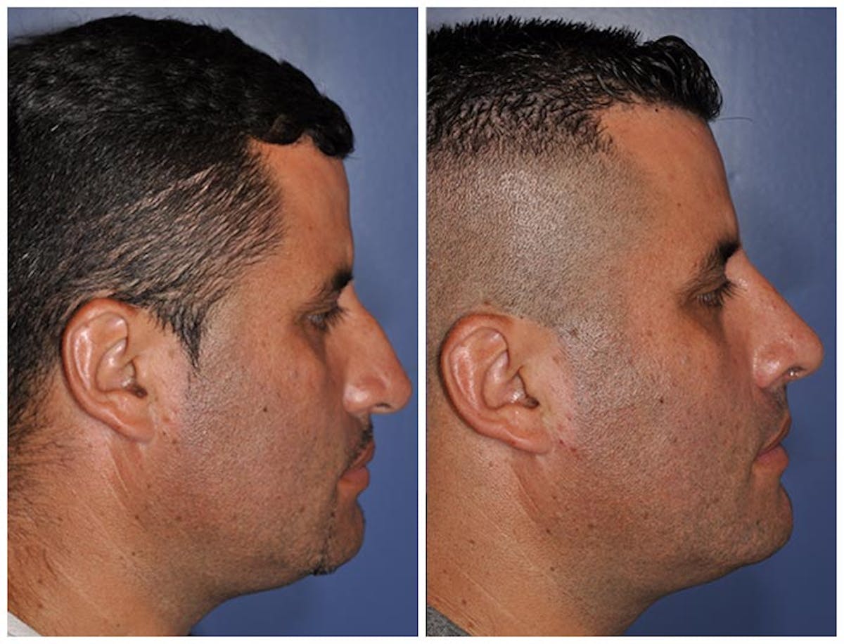 Rhinoplasty Before & After Gallery - Patient 126768 - Image 1