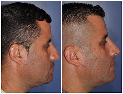 Rhinoplasty Before & After Gallery - Patient 126768 - Image 1