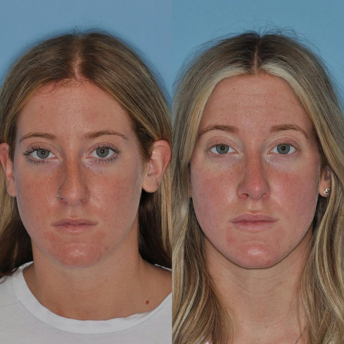 Rhinoplasty Before & After Gallery - Patient 372438 - Image 3