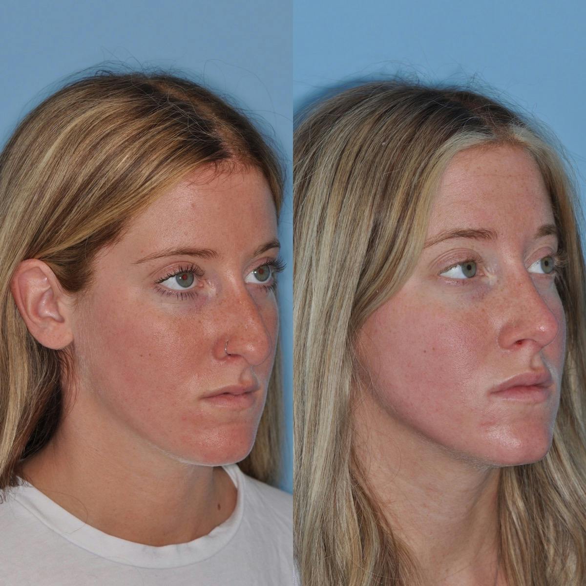 Rhinoplasty Before & After Gallery - Patient 372438 - Image 4