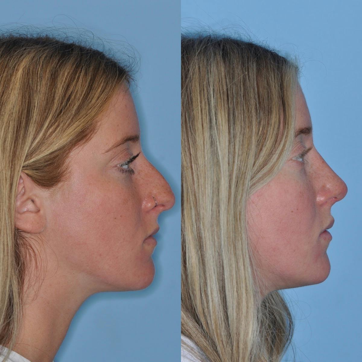 Rhinoplasty Before & After Gallery - Patient 372438 - Image 5