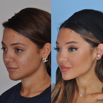 Rhinoplasty Before & After Gallery - Patient 124678 - Image 1