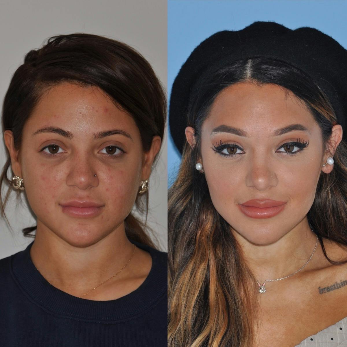 Rhinoplasty Before & After Gallery - Patient 124678 - Image 2