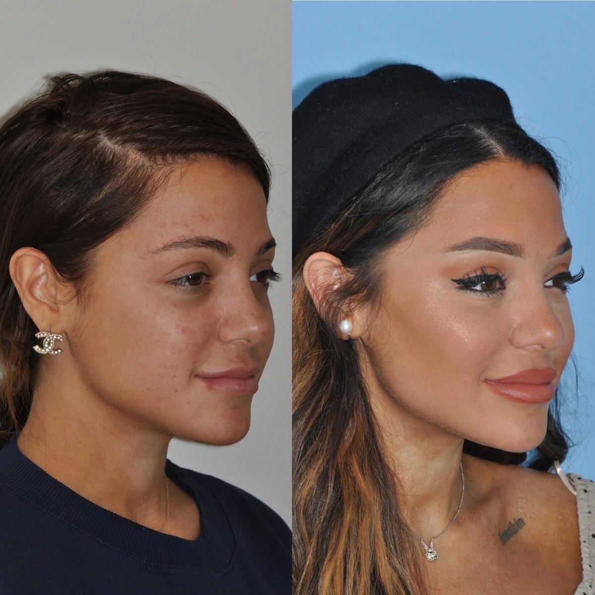 Rhinoplasty Before & After Gallery - Patient 124678 - Image 3