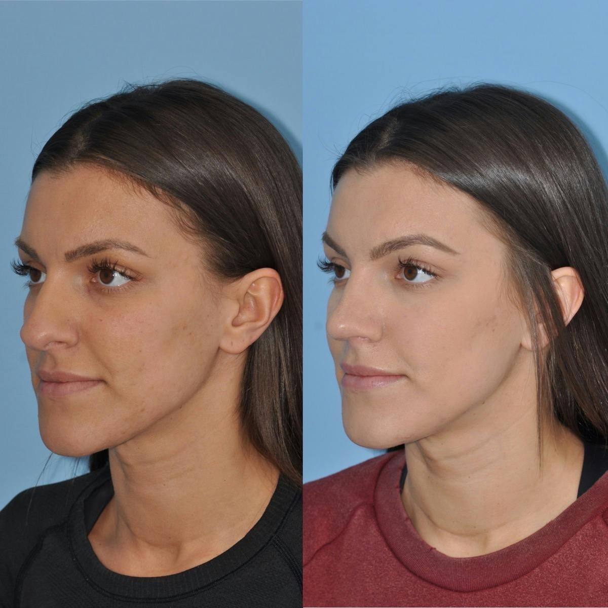 Rhinoplasty Before & After Gallery - Patient 156799 - Image 1