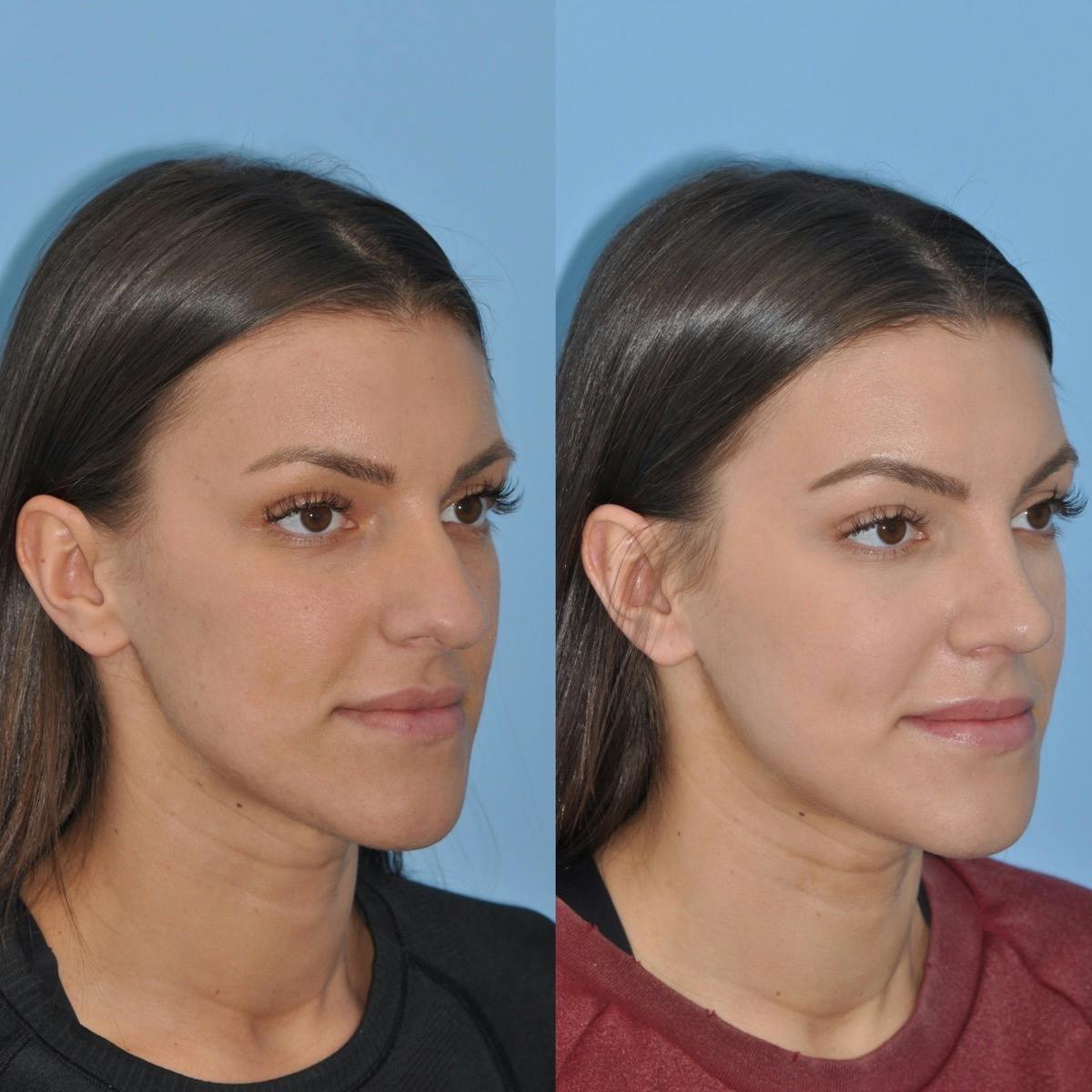 Rhinoplasty Before & After Gallery - Patient 156799 - Image 3
