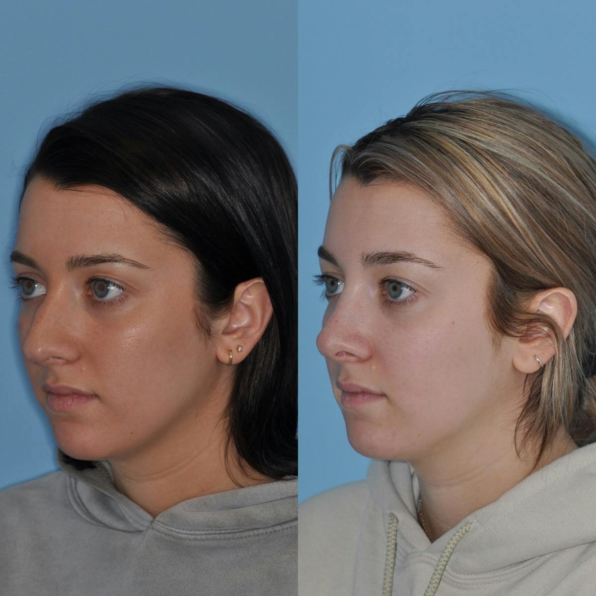 Rhinoplasty Before & After Gallery - Patient 142904 - Image 1