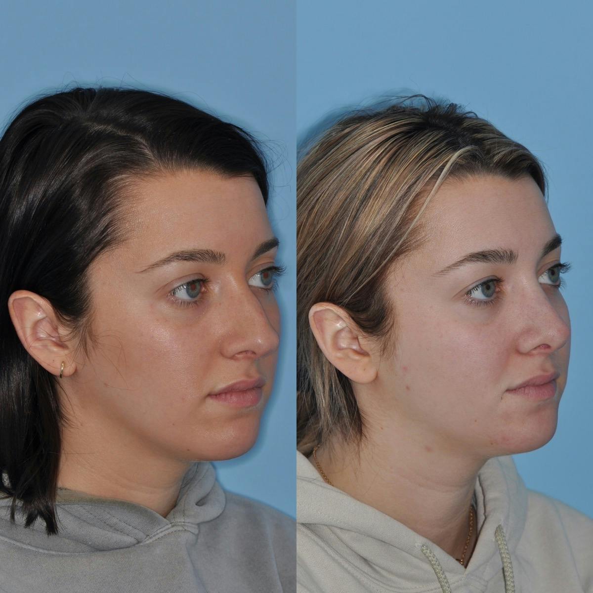 Rhinoplasty Before & After Gallery - Patient 142904 - Image 2