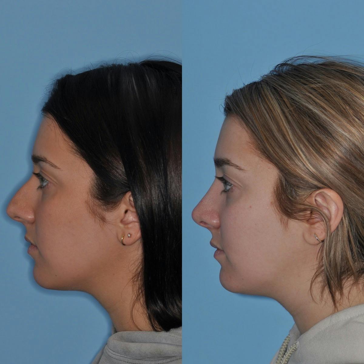 Rhinoplasty Before & After Gallery - Patient 142904 - Image 3
