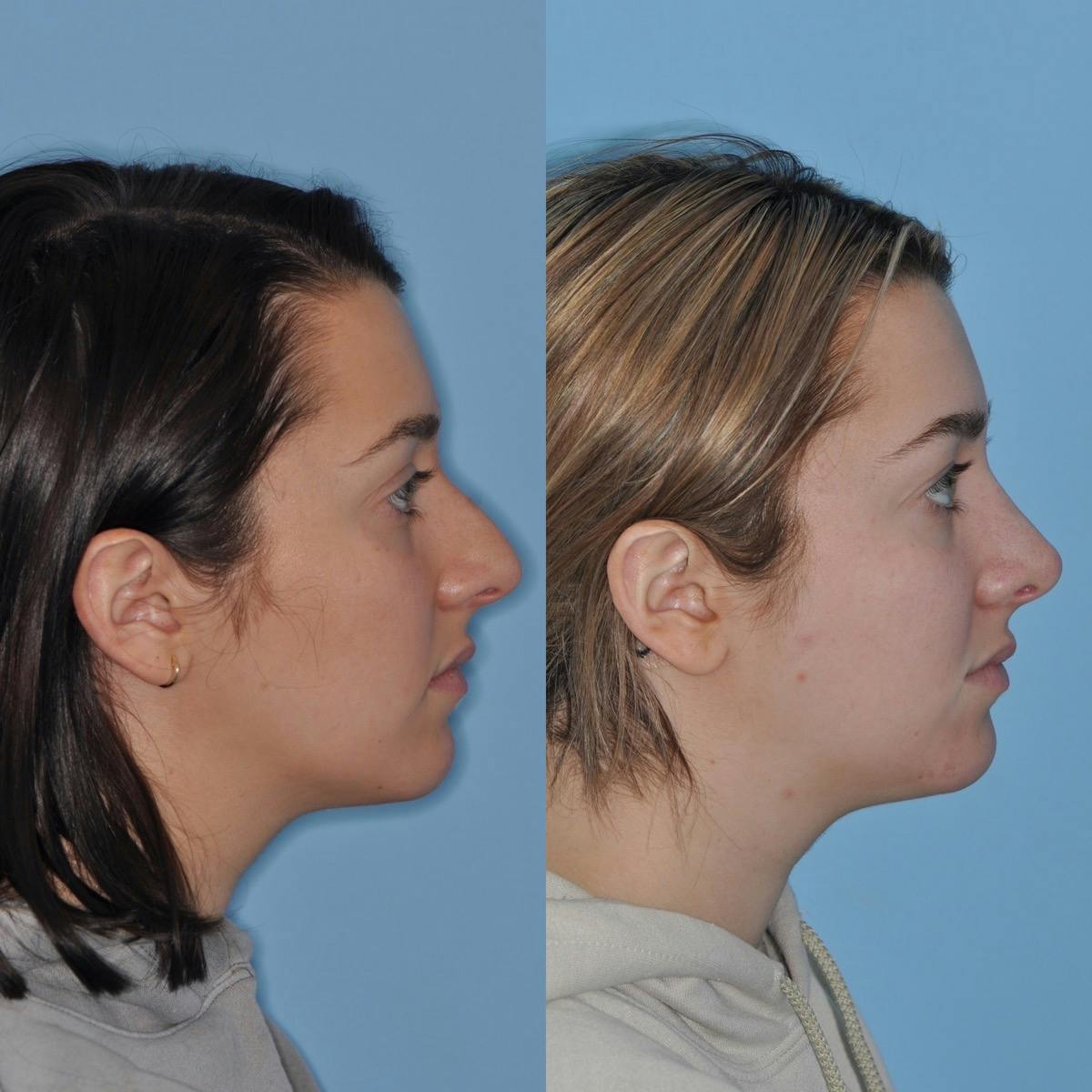 Rhinoplasty Before & After Gallery - Patient 142904 - Image 4