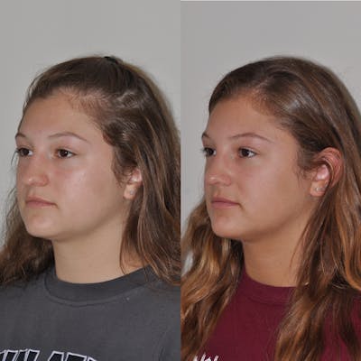 Rhinoplasty Before & After Gallery - Patient 203434 - Image 1